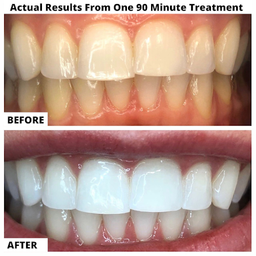 We Whiten Teeth Whitening